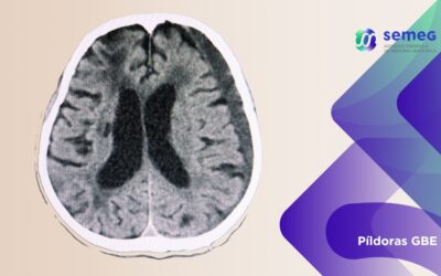 Embolización de la arteria meníngea media y hematoma subdural no agudo