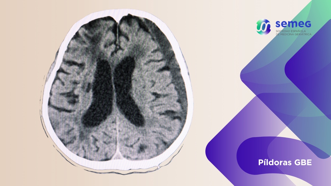 SEMEG Embolización de la arteria meníngea media y hematoma subdural no agudo