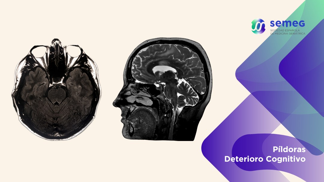Una simple resonancia cerebral pudiera anticipar el riesgo de deterioro cognitivo