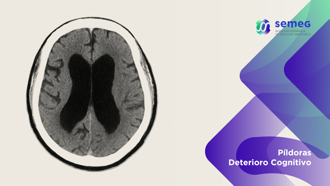 semeg hidrocefalia normotensiva (HNT) semeg hidrocefalia normotensiva (HNT)