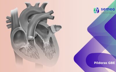 El cierre percutáneo de la orejuela auricular izquierda en FA vuelve a fallar