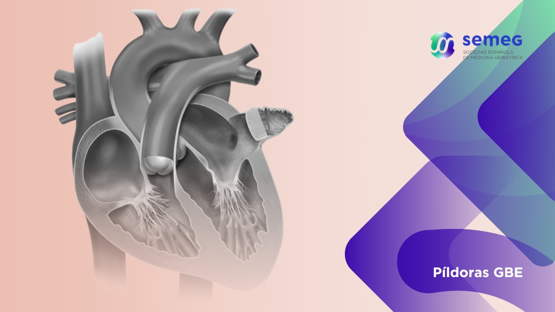 EL CIERRE PERCUTÁNEO DE LA OREJUELA AURICULAR IZQUIERDA EN LA FA VUELVE A FALLAR