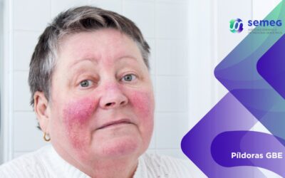 La rosácea pasa desapercibida pese a su alta frecuencia