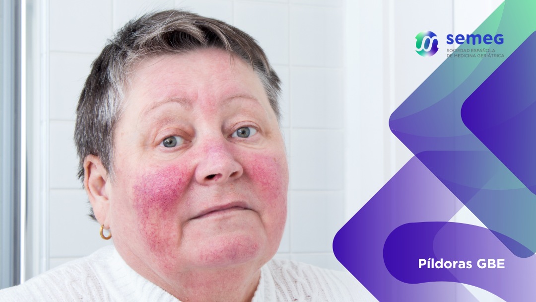 SEMEG Rosácea infradiagnosticada en personas mayores