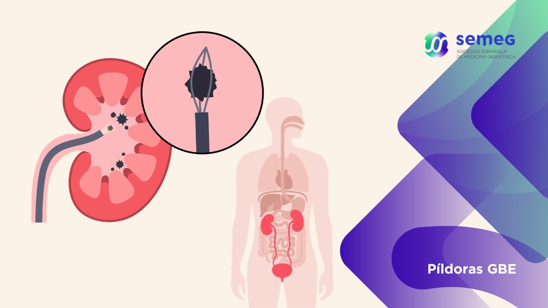 SEMEG Cirugía endoscopica de litiasis de pacientees encamados SEMEG CIRUGÍA ENDOSCÓPICA DE LITIASIS EN PACIENTES ENCAMADOS